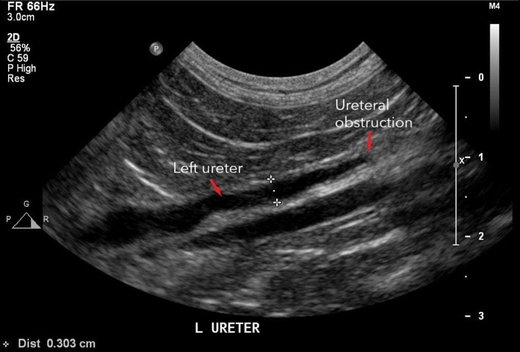 Ultrasound image of Maggie's first ureter blockage