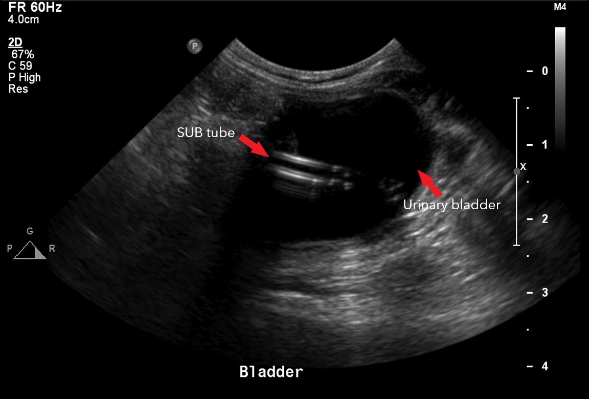 Ultrasound image showing the SUB in the urinary bladder