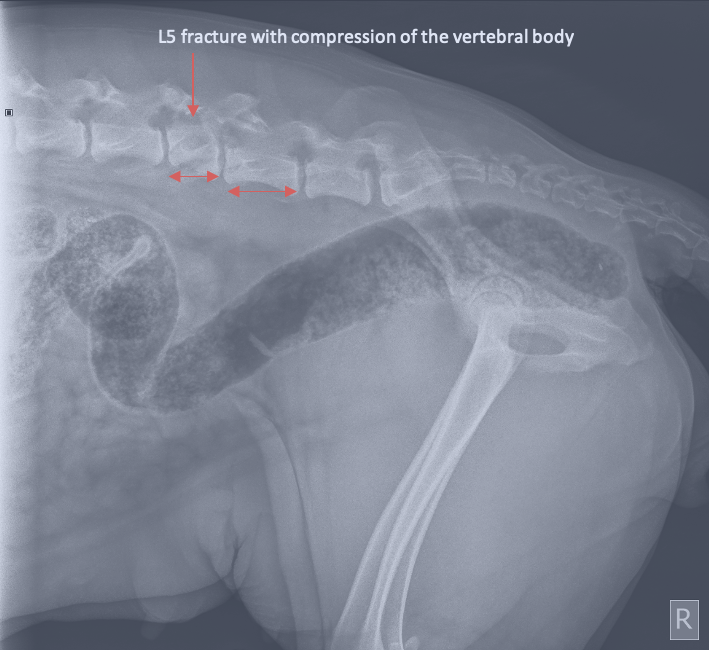 x-ray showing cassie's compression fracture